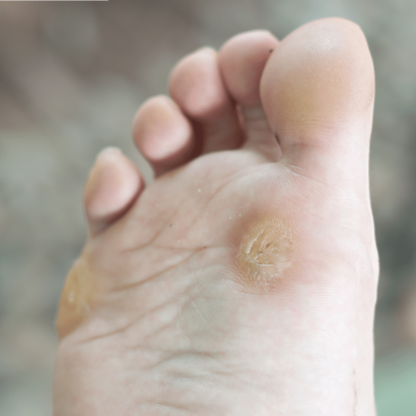 Plantar Warts